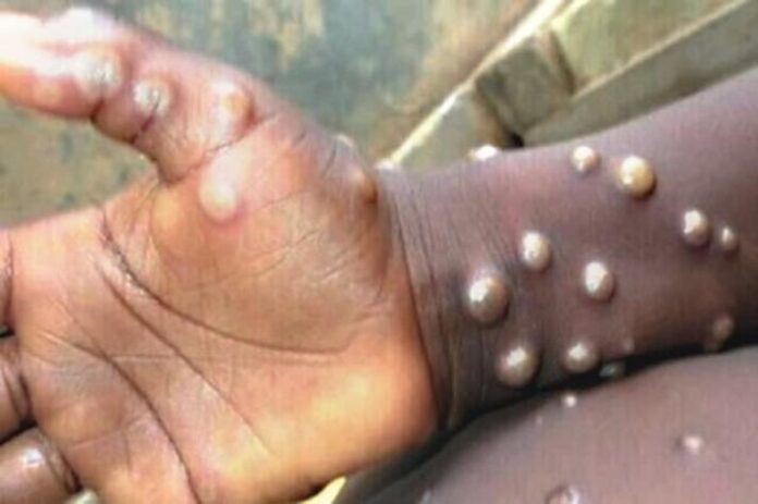 Ghana's MPOX cases surge to 85